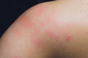 Лишай у дитини: ефективні методи лікування та поради лікарів