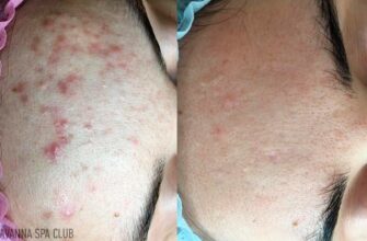 Мезотерапія волосся: Порівняння результатів до та після процедур