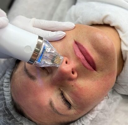 Мікронідлінг: Ефективність та результати до і після процедури