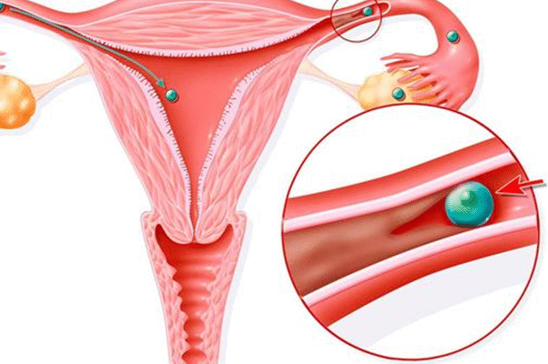 Місячні після видалення спіралі: що очікувати і як адаптуватися