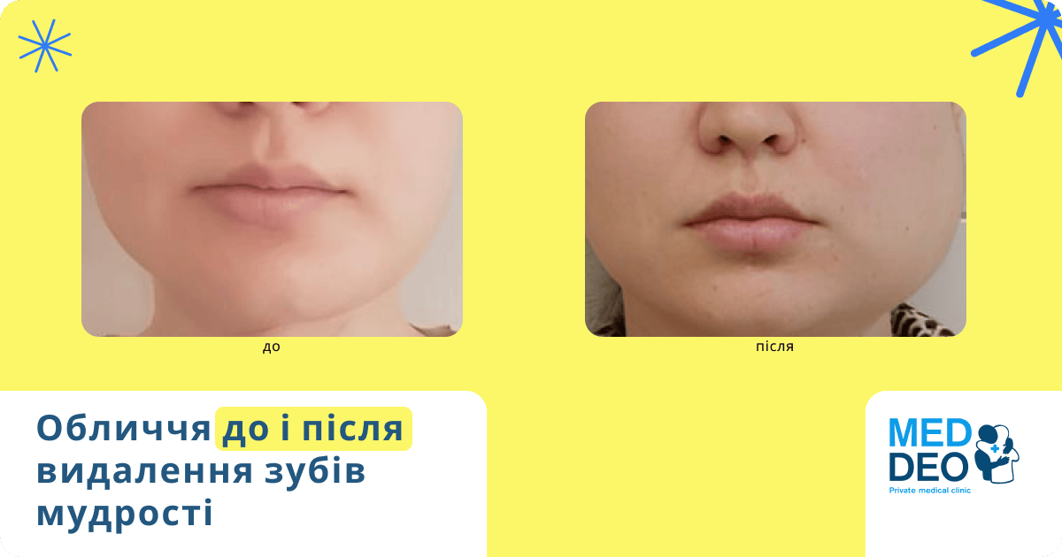 Ускладнення після видалення зуба мудрості | Med Deo