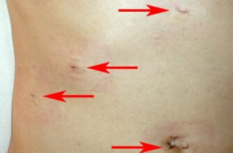 На якому боці краще спати після видалення жовчного міхура? Поради лікарів