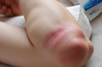 Набряк після ендопротезування: як уникнути та ефективно боротися