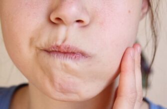 Набряк після кісткової пластики: причини, симптоми та лікування