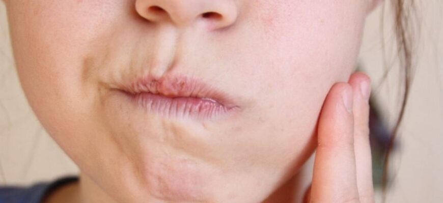 Набряк після кісткової пластики: причини, симптоми та лікування