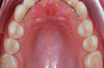 Наслідки після брекетів: зміни в здоров’ї зубів та загального стану