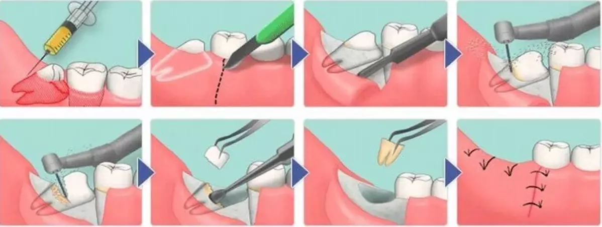 Зуб мудрості, видаляти чи ні? - Дитяча стоматологія в Києві ...