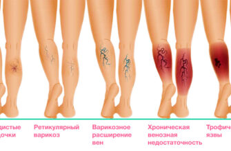 Найефективніші методи лікування трофічних виразок: рекомендації фахівців