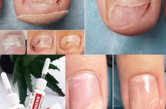 Найкращі ліки для ефективного лікування екземи: огляд та поради