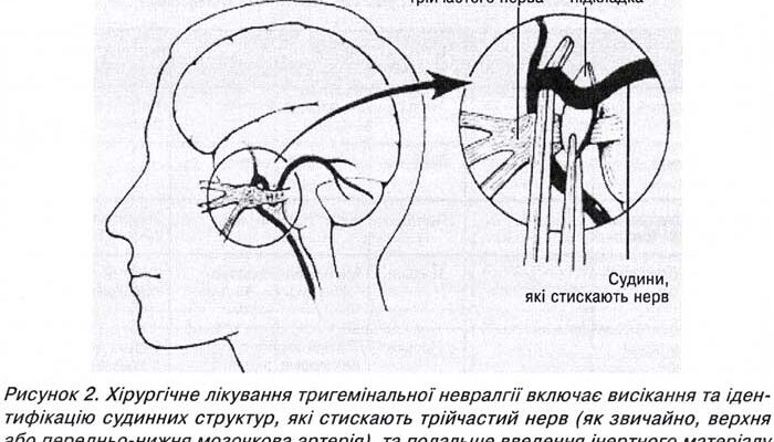 Нейропатичний біль: причини, симптоми та ефективне лікування