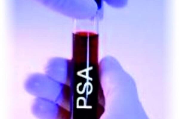 Норма ПСА після видалення простати: що потрібно знати для здоров’я