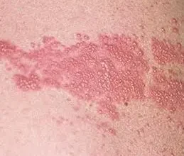 Ниюча біль під лівою лопаткою: причини, діагностика та лікування