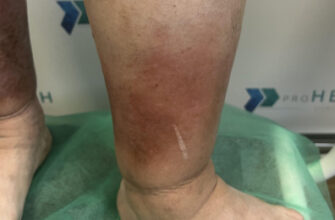 Ниюча біль в литках: причини, симптоми та методи лікування