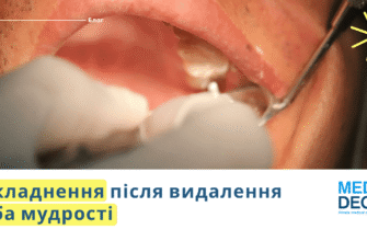 Ниючий біль після видалення зуба: причини та ефективні методи полегшення