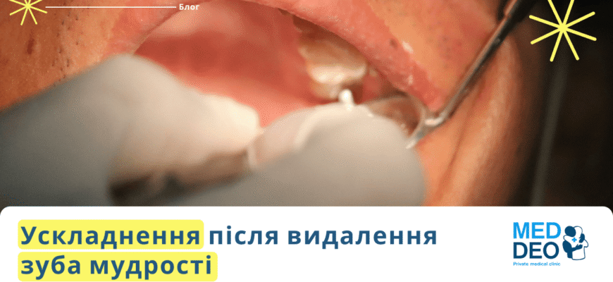 Ниючий біль після видалення зуба: причини та ефективні методи полегшення
