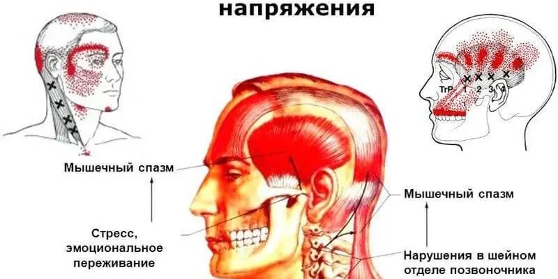 Обговорення симптомів і лікування головного болю напруги на форумі