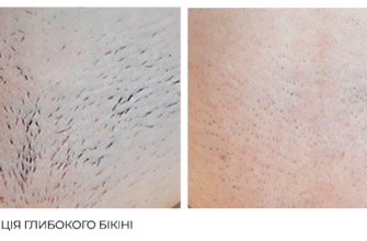 Обмеження після лазерної епіляції: що заборонено робити для безпеки?