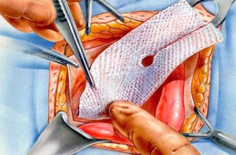 Обмеження після операції на грижу: чого не слід робити для успішного відновлення