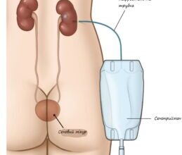 Оптимальна дієта після видалення нирки: поради для швидкого відновлення