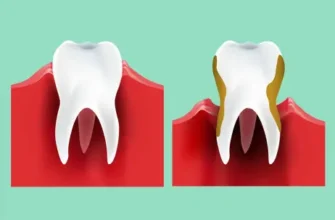 Пародонтит vs Пародонтоз: ключові відмінності та особливості захворювань