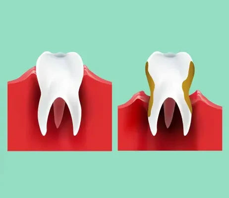 Пародонтит vs Пародонтоз: ключові відмінності та особливості захворювань