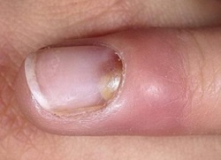 Пекучий біль у пальцях ніг: причини, симптоми та лікування