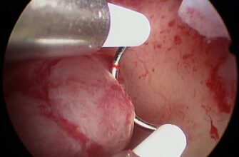 Перші місячні після гістероскопії: чого очікувати та як підготуватись