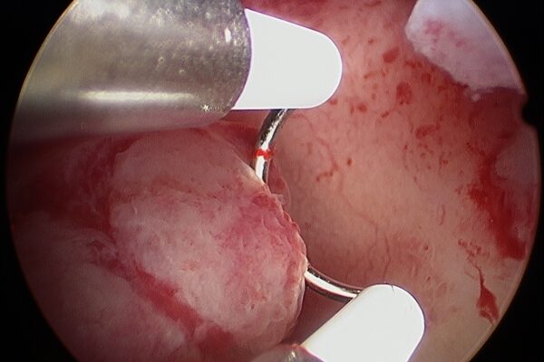 Перші місячні після гістероскопії: чого очікувати та як підготуватись