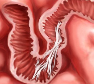 Клініка Біляка | Операція при раку товстої кишки в Ужгороді ...