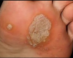 Підошовні бородавки - Як швидко Видалити підошовну бородавку