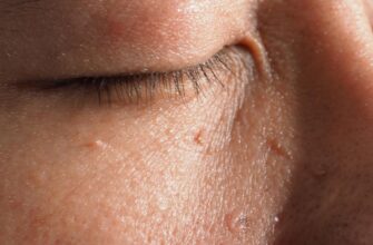 Післявидалення бородавки: можливі наслідки та як їх уникнути