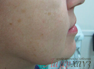 Плазмоліфтинг обличчя: ефекти та результати до і після процедури