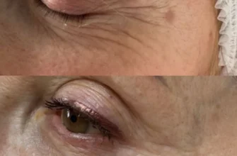 Полімолочна кислота: ефективність до і після застосування препаратів