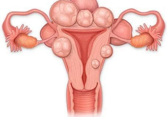 Постпункційний головний біль: причини, симптоми та ефективне лікування