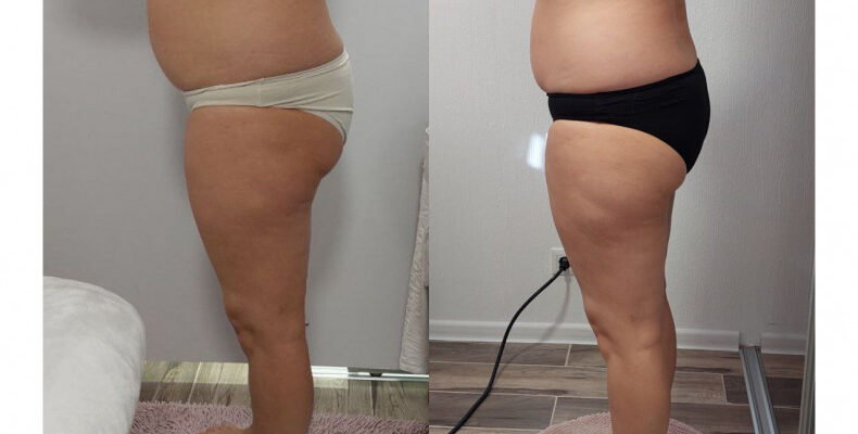 Пресотерапія до і після: Зміни та результати процедури в деталях