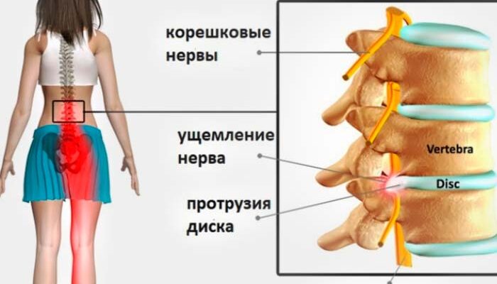 Протрузія чи грижа: основні відмінності та особливості захворювань