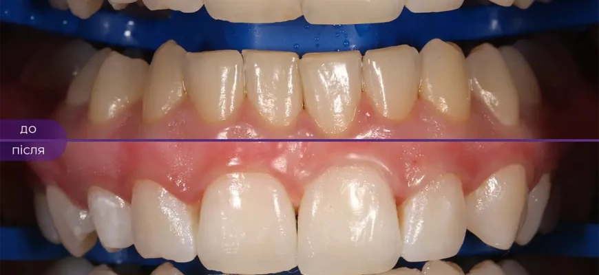 Причини болю в зубах після професійної чистки та що робити далі