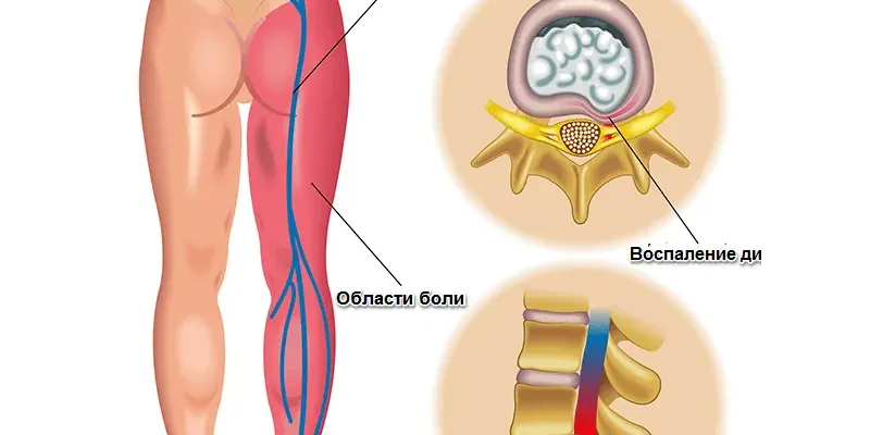 Причини і лікування болю в правому боці під час статевого акту