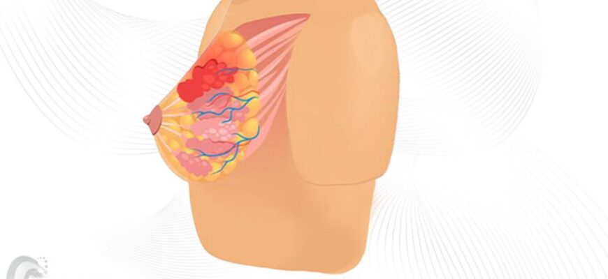 Причини та лікування болю в грудях у жінок: що потрібно знати