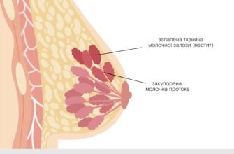 Причини та лікування болю в грудній клітці: Повний гід для вас