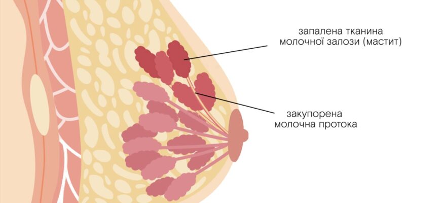 Причини та лікування болю в грудній клітці: Повний гід для вас