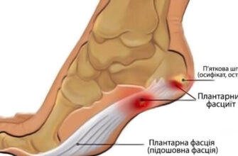 Причини та лікування болю в п’яті з зовнішньої сторони: поради лікарів