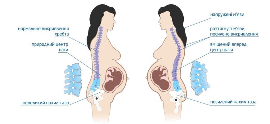 Причини та лікування болю в спині на ранніх термінах вагітності