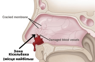 Причини та лікування: чому з’являються кров з носа і головний біль?