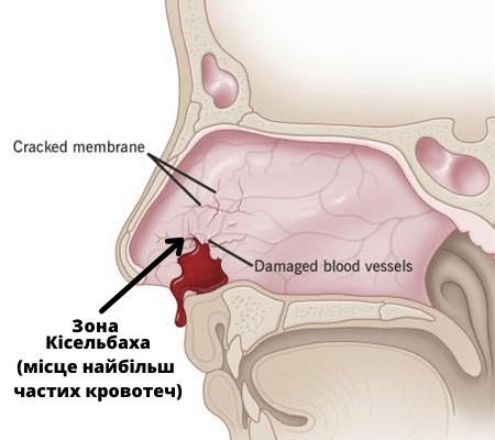 Причини та лікування: чому з’являються кров з носа і головний біль?
