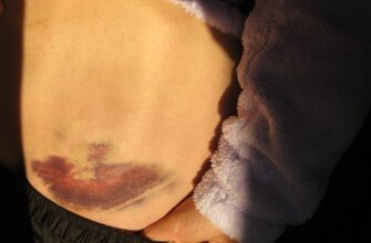 Причини та лікування гематом після хірургічних втручань: поради лікарів