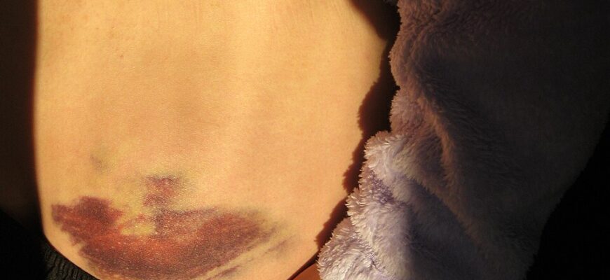 Причини та лікування гематом після хірургічних втручань: поради лікарів