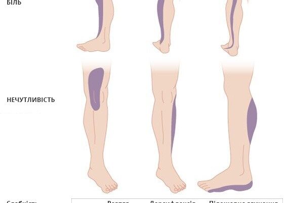 Причини та лікування ниючого болю в попереку зліва: детальний огляд
