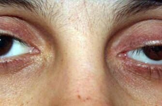 Причини та лікування птозу повіки після ін’єкцій ботоксу