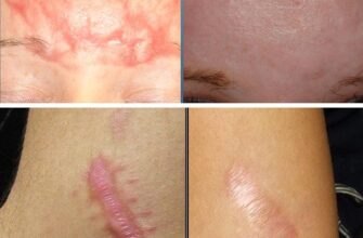 Причини та лікування твердого шва після операції: що важливо знати